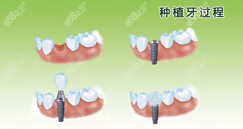 南京雅度口腔种植牙技术