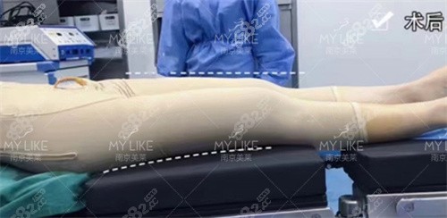 <!--<i data=20240705-sp></i>-->腿部吸脂图片术后