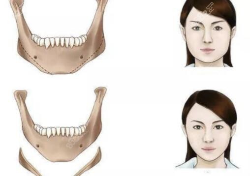 做下颌角术后脸易垮吗