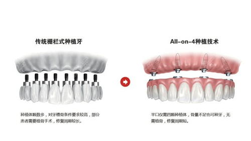 all-on-4种植牙技术和传统种植牙的区别