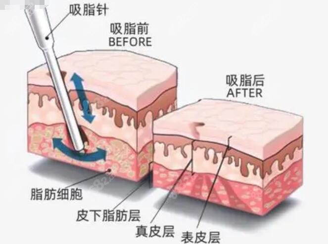 深圳吸脂好的医生胡广孙