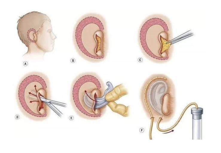 做耳再造手术要具备什么www.8682.cc