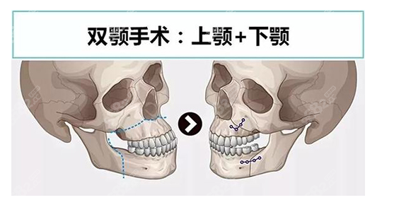 ：双鄂手术是正颌手术