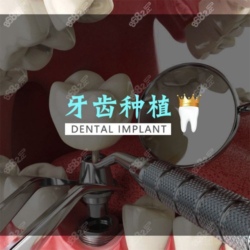 牙齿种植示意图