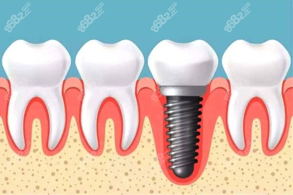 种植牙多少钱一颗2023价格表