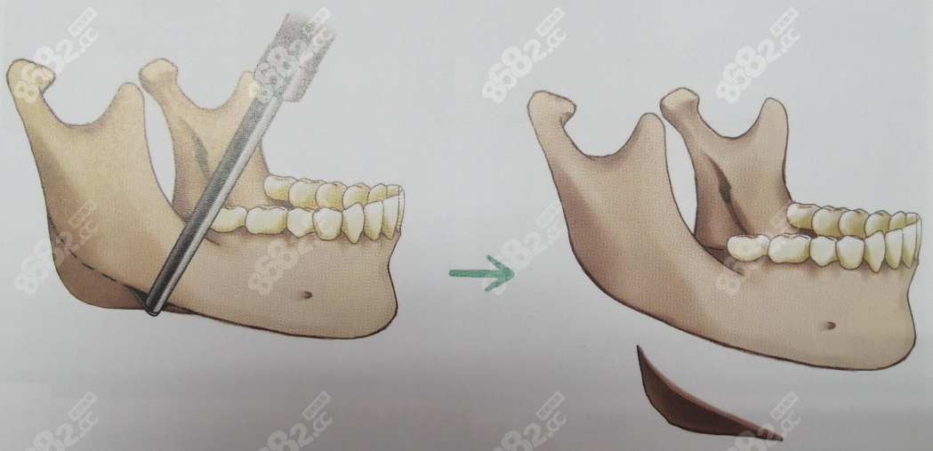 下颌角截骨手术www.8682.cc