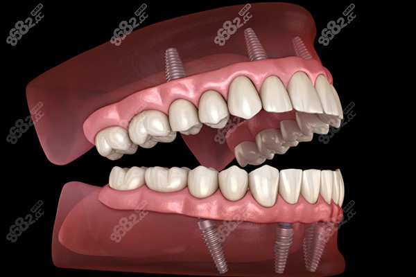 2023全口种植牙齿一般需要多少钱