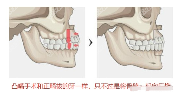 双鄂手术和凸嘴手术的区别