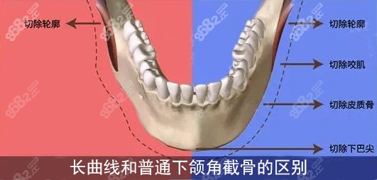 长曲线下颌角和普通下颌角截骨的区别