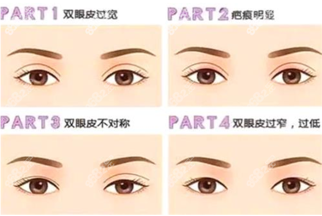 韩国眼修复靠谱的医院可修复的眼睛类型8682.cc