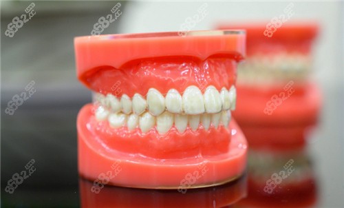 牙套模型图示