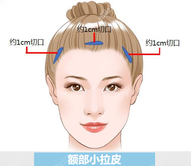 杭州面部小切口拉皮除皱医院哪家好8682.cc