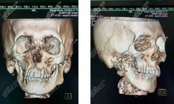 3D打印假体需要做的检查