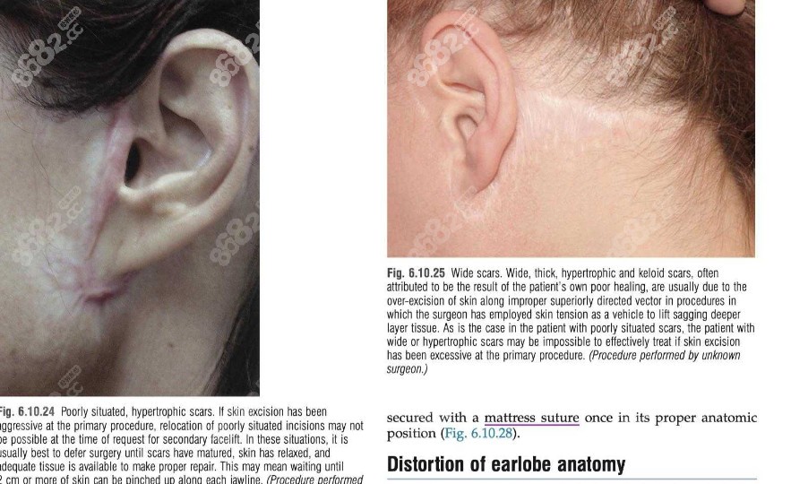 其他医院做面部拉皮手术导致耳朵变形的实例