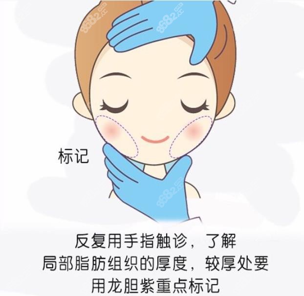 长沙面部吸脂哪个医生好