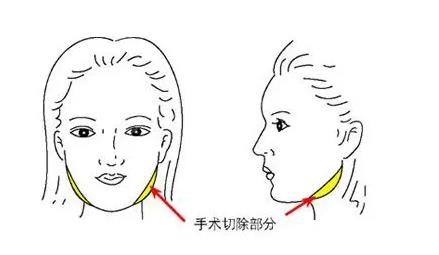 项昌峰磨骨事例前后对比