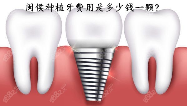 福州闽侯种植牙多少钱一颗