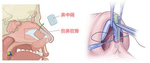 海口华美整形做鼻子技术图