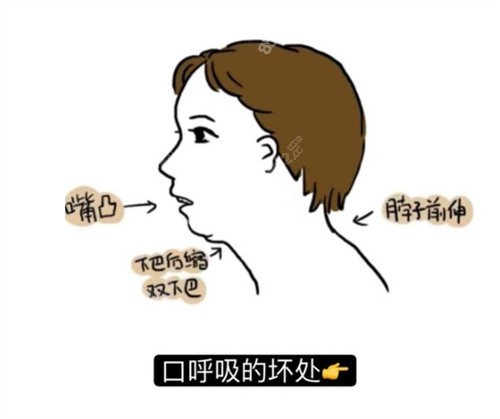 口呼吸嘴凸、下巴后缩矫正方法