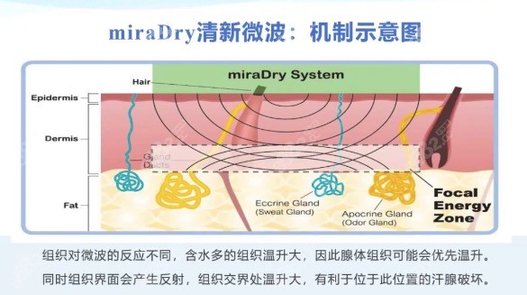 美国miraDry清新微波除腋臭原理图