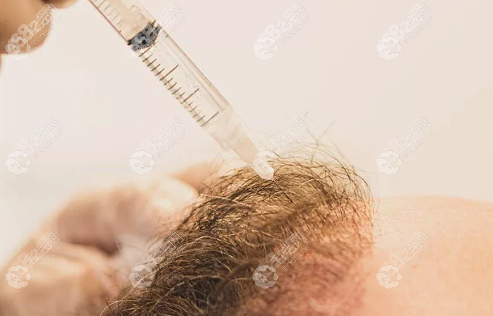 美丝沛用几个疗程能治好脱发