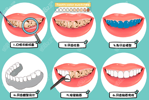 西安团圆口腔牙贴面