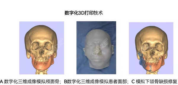 3d打印假体的好处
