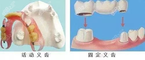 <!--<i data=20240705-sp></i>-->镶牙的价格