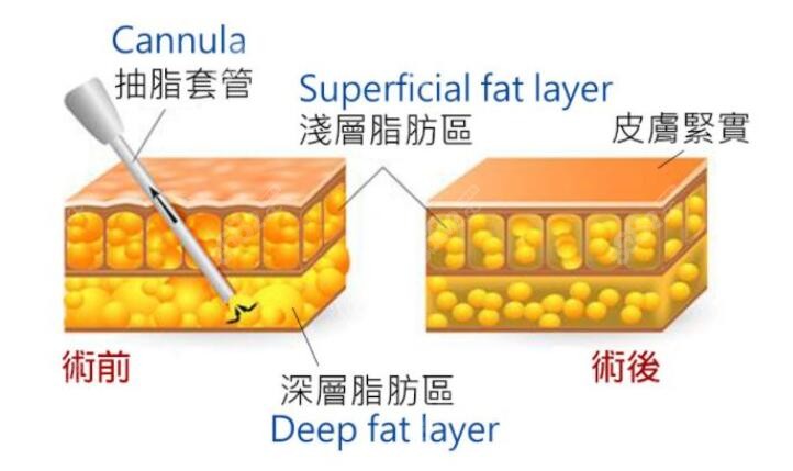 吸脂的演示图