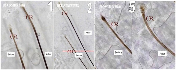美丝沛治疗脱发真的管用吗