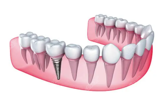 东莞种植牙多少钱一颗2023年