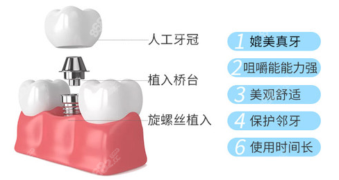 东莞全口种植牙价格