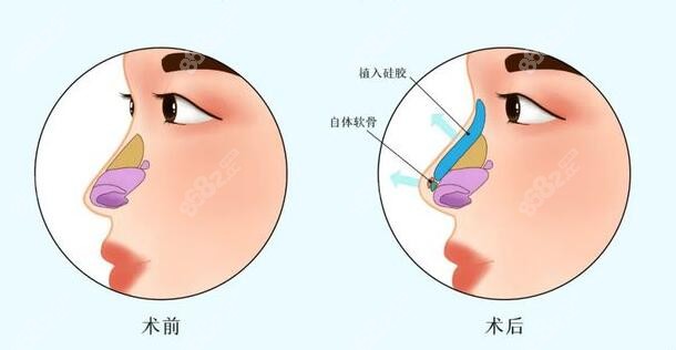 韩国温度整形医院做鼻子的主要材料