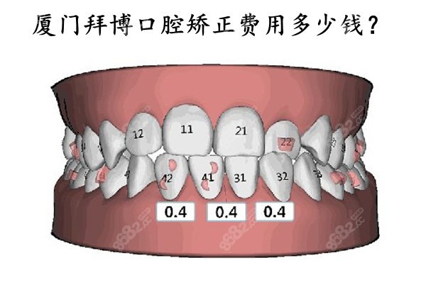 厦门拜博口腔矫正费用