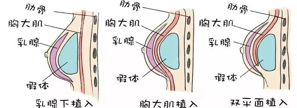 国内外隆胸技术