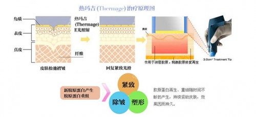 热玛吉面部除皱原理