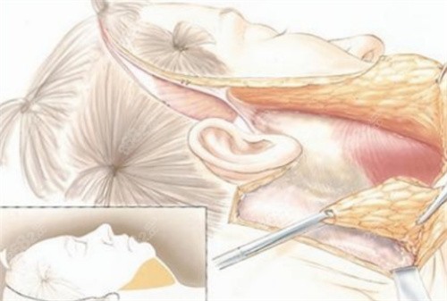 传统拉皮手术切口