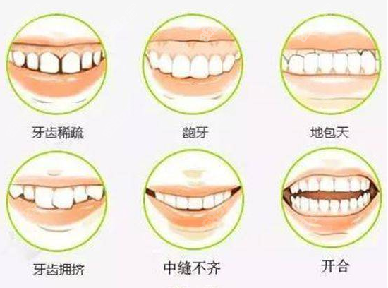 MTA极速美学矫正价格和牙齿情况问题等来定