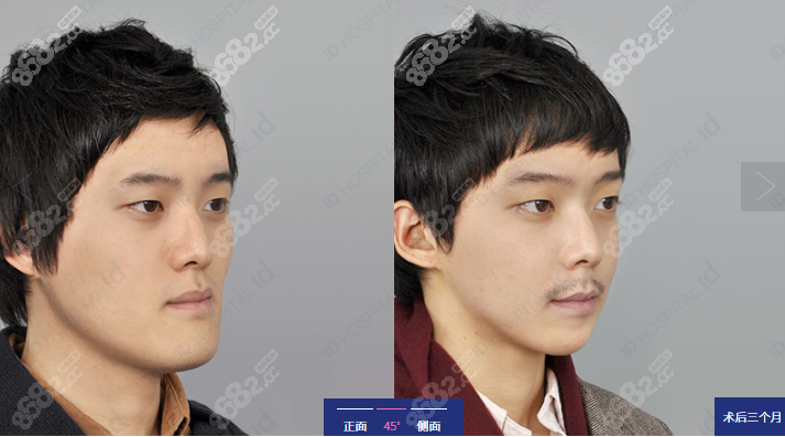 反颌手术后脸型改变图