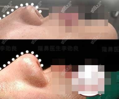 李劲良鼻修复病例展示8682.cc