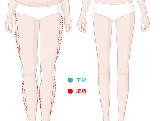 成都o型腿矫正手术价格