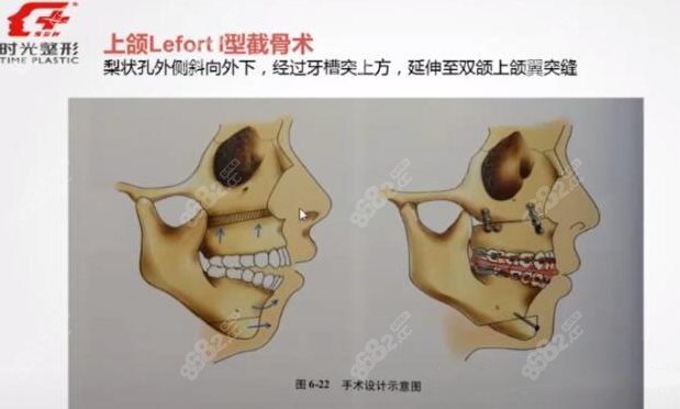 上颌Lefort l型截骨术过程图示