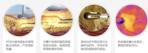 黄金微雕手术过程