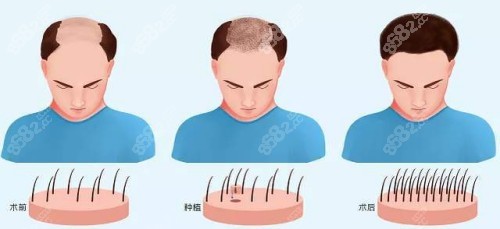 深圳鹏程医院植发口碑
