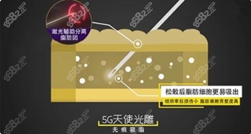 5g天使光雕吸脂过程揭秘m.8682.cc