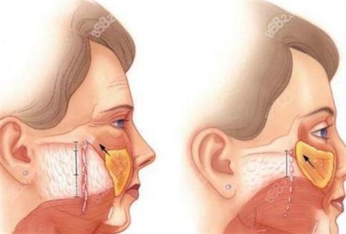 传统拉皮手术切口