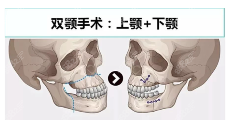 正颌手术过程和步骤图片
