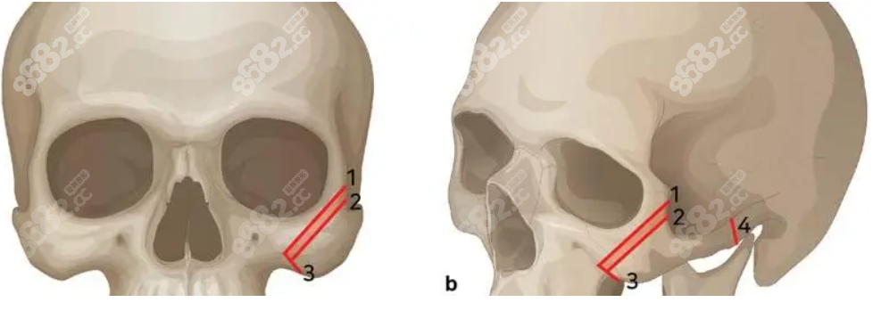 颧骨颧弓L型截骨怎么做