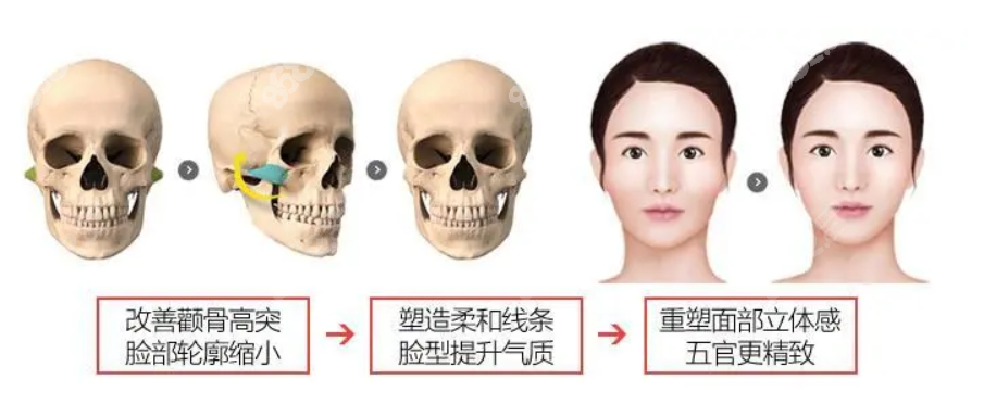 颧骨缩小I型截骨、L型截骨和矩形截骨区别