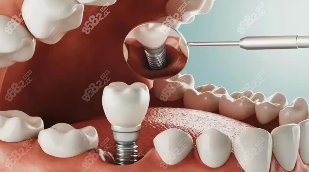 单颗种植牙示意图8682.cc